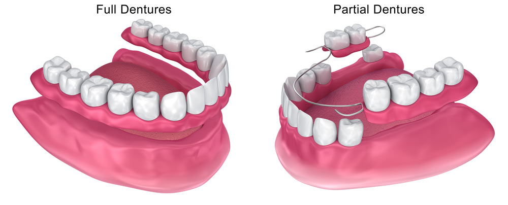 Full dentures and Partial dentures