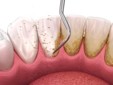 Tulsa dental hygienist removing tartar during teeth cleaning